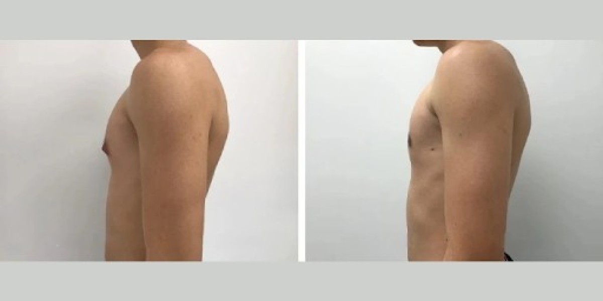 Top Signs You May Have Gynecomastia in Dubai