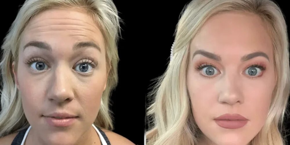 Inside the Botox Room With the Best Doctors in dubai