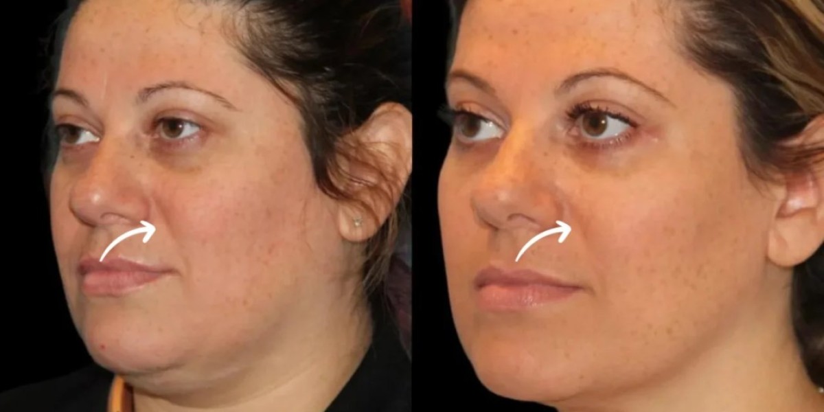 History of Sculptra Fillers and Their Adoption by  Dubais Best Plastic Surgeons