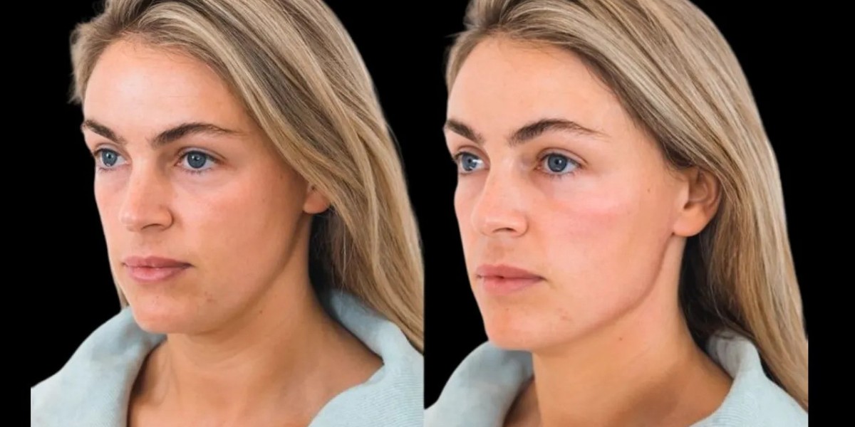 Best Doctors in Dubai: Enhance Your Features with Cheek Fillers