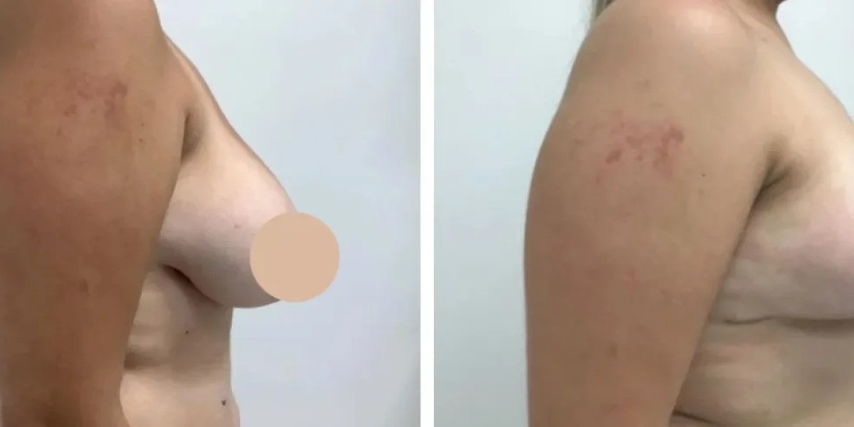 Where Skill Meets Precision: Best Doctors in Dubai for Breast Reduction Surgery
