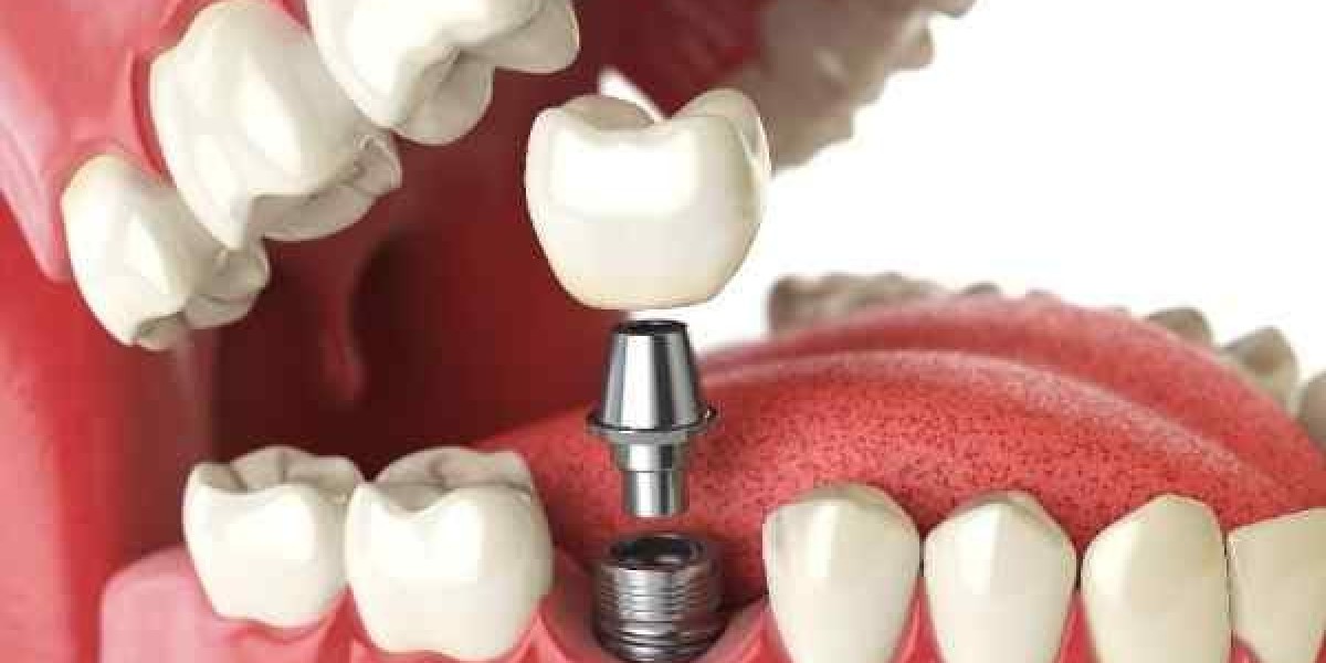 What Happens If a Temporary Implant Crown Falls Off?