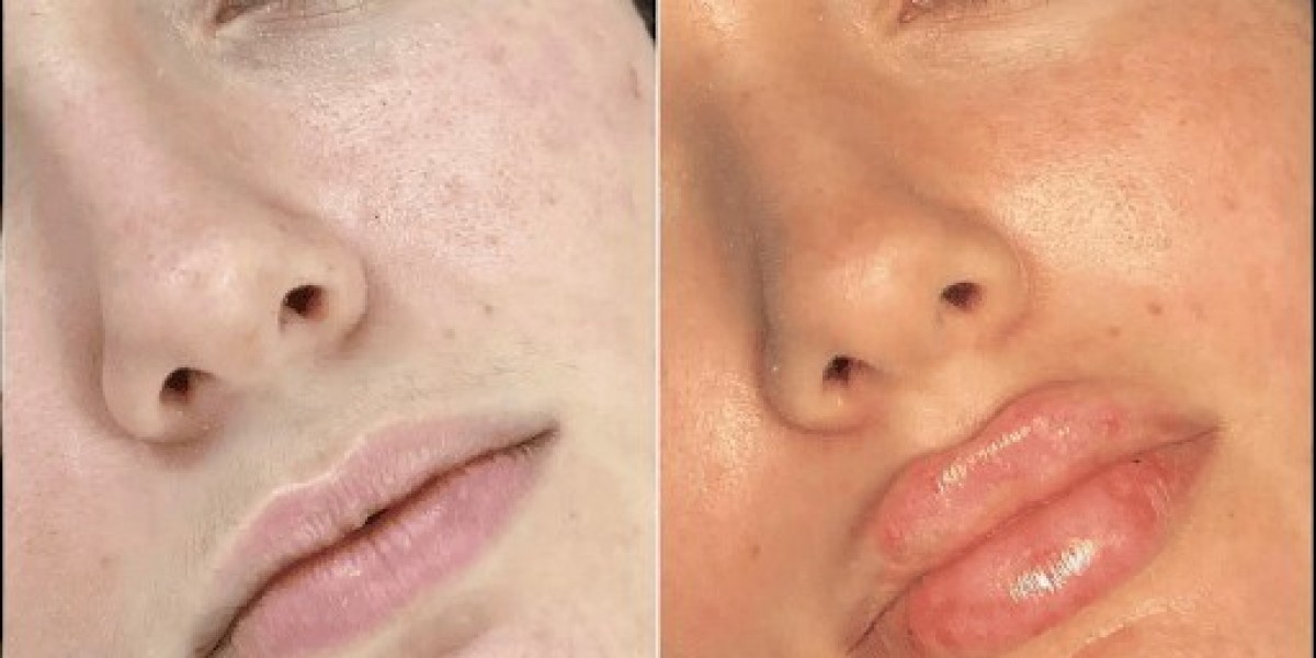 The Art of Aesthetics by the Best Doctors in Dubai for Fillers