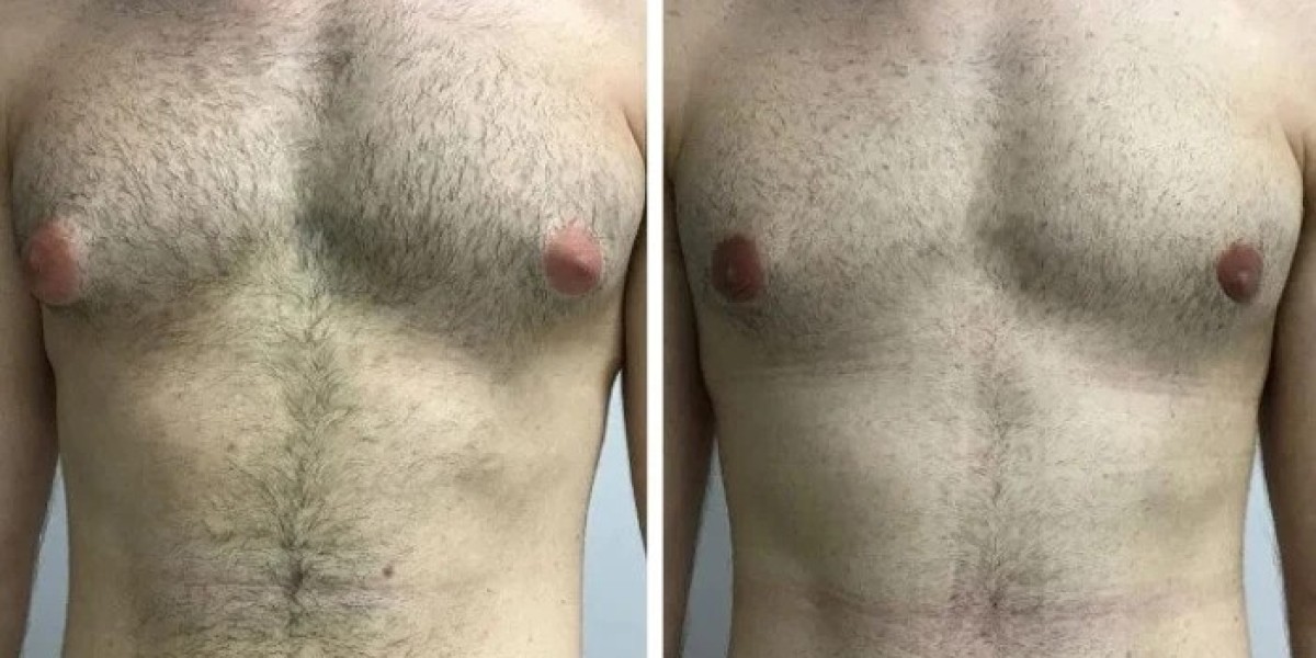 Best Doctors in Dubai: Top Questions to Ask Before Gynecomastia Surgery