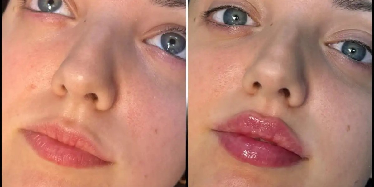 Expert Tips from the Best Doctors in Dubai for Fillers