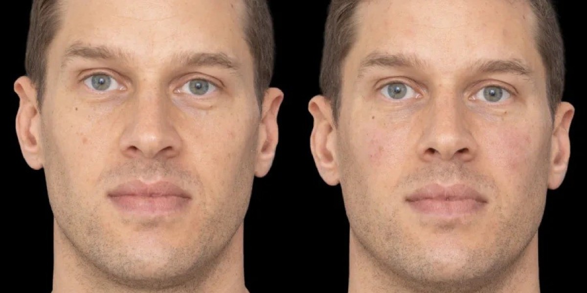 Experts: Best Doctors in Dubai for Under Eye Fillers Procedures