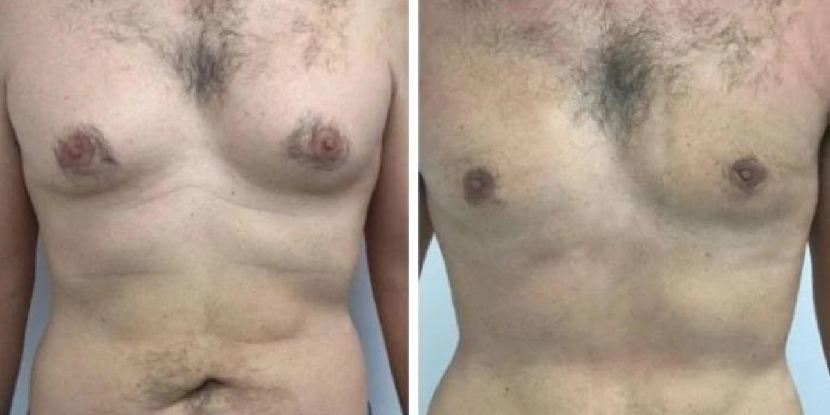 Gynecomastia in Dubai: Guide Toward a Successful Surgical Experience