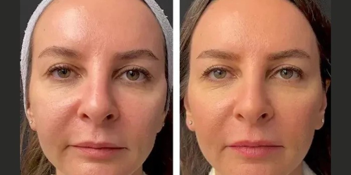 Mesotherapy vs. Other Treatments: Why the Best Aesthetic Clinics in Dubai Prefer It
